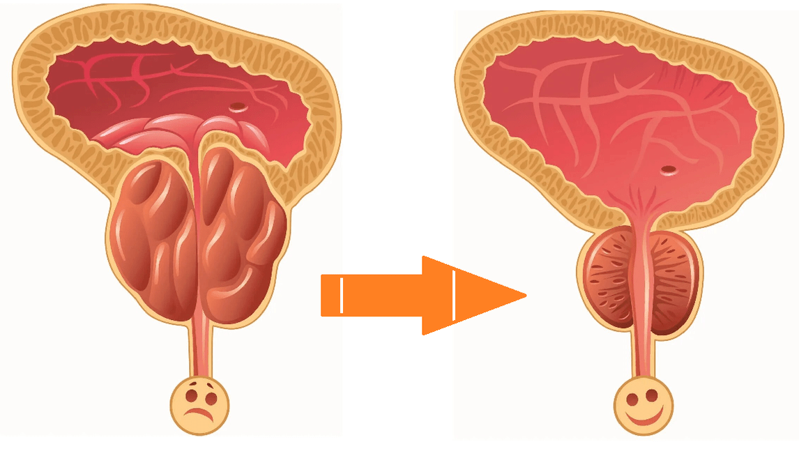 Efecto de Uromexil Forte na próstata con prostatite e adenoma