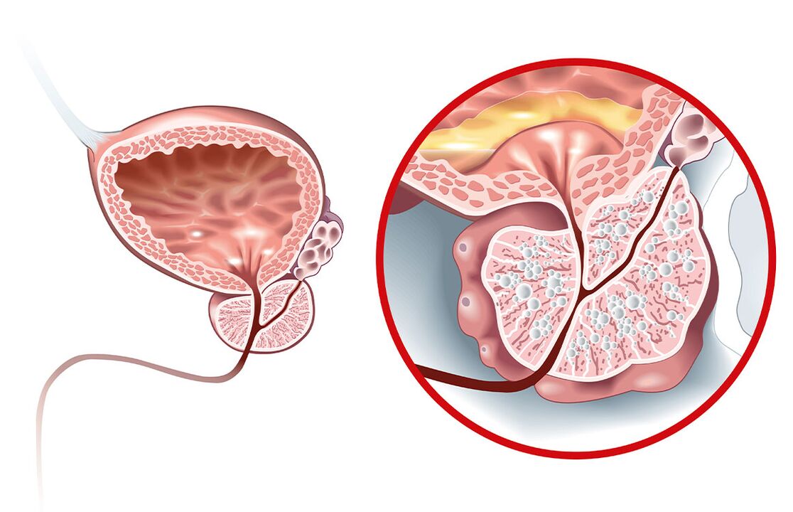 Que pasa coa próstata con adenoma e prostatite